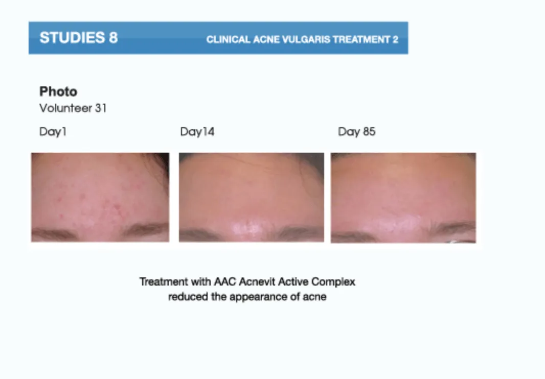 AcneVit Anti-Acne Cleansing Gel